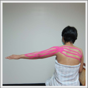 kinesio taping