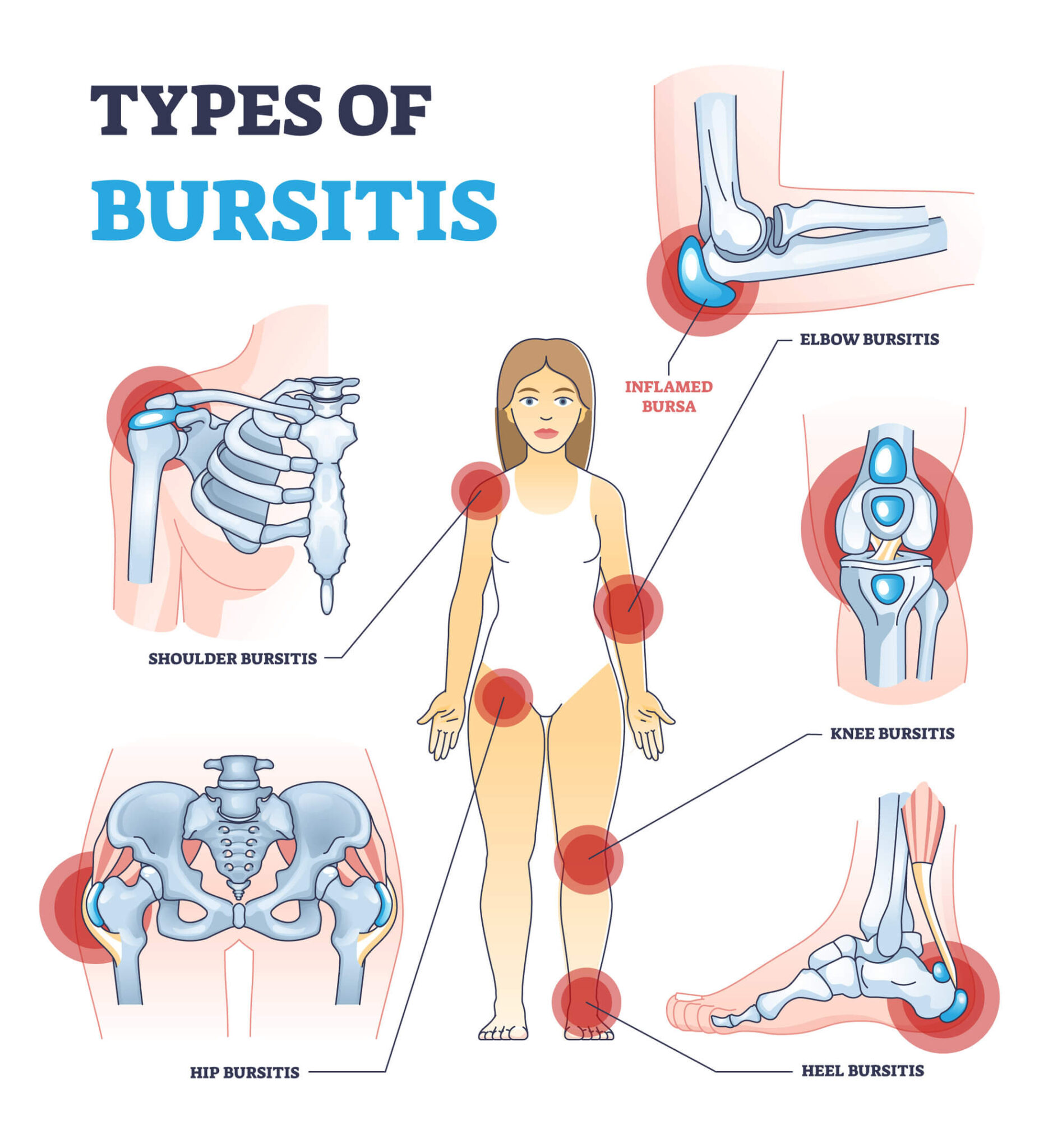 Tendonitis versus Bursitis ⋆ Sunnybrae Therapeutics